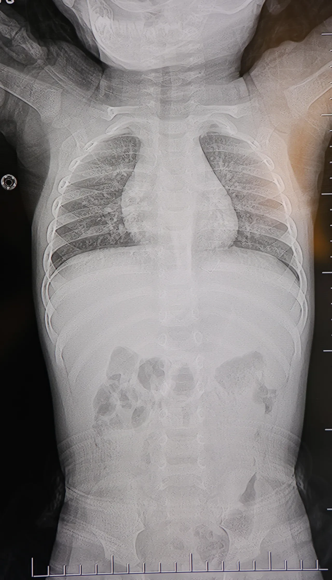 Bebeğin sırtından çıkan cisim şok etti! Gerçek hastanede ortaya çıktı