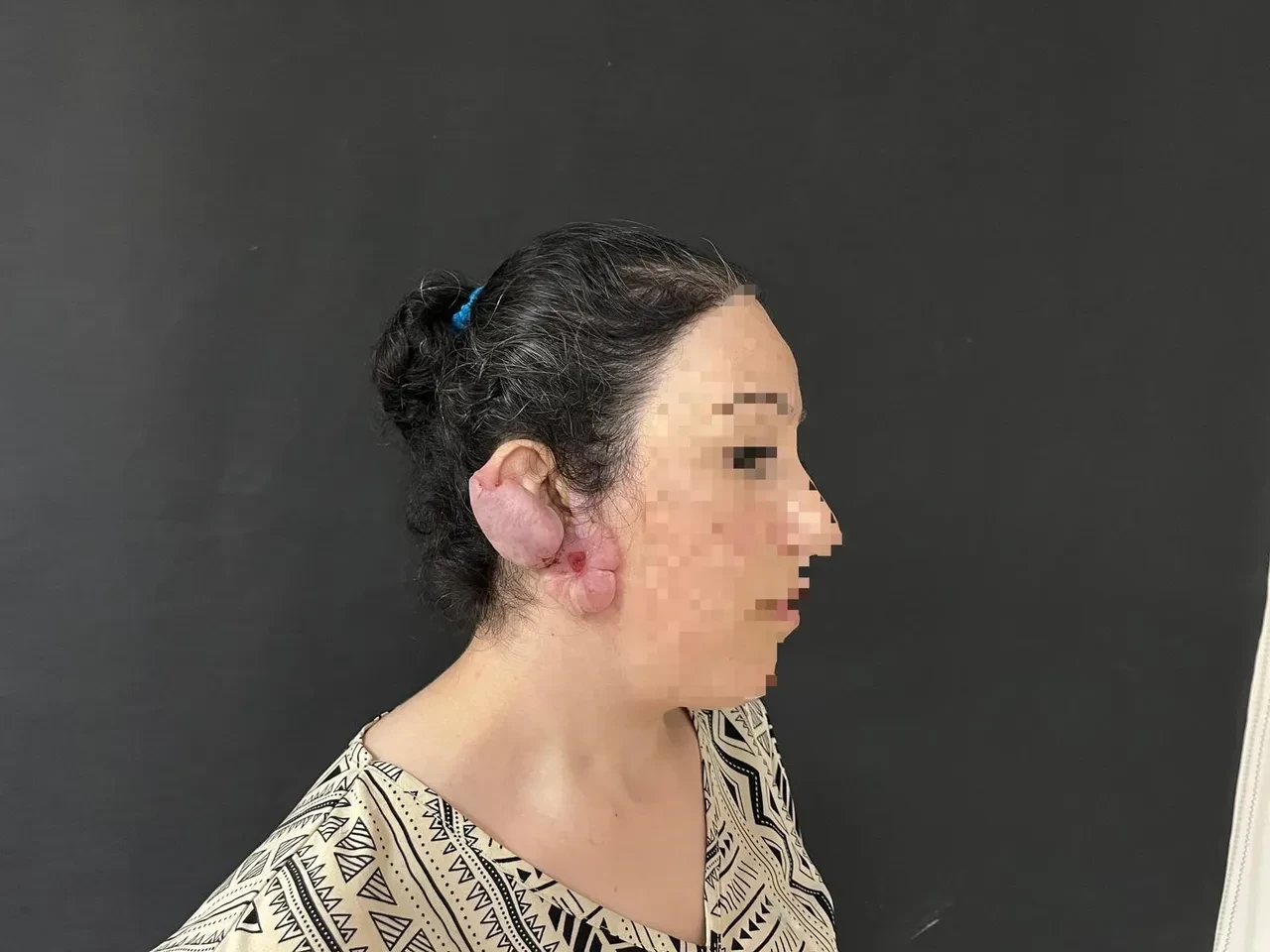 Çocukken delinen kulağı kabusu oldu! Genç kadın yıllar sonra ödüllü teknikle sağlığına kavuşabildi