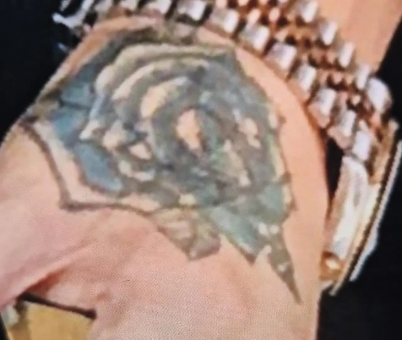 Dövmesini sildirmek istedi, eli delik deşik oldu! Kabusa dönen işlem: Deri nakli yapılacak 