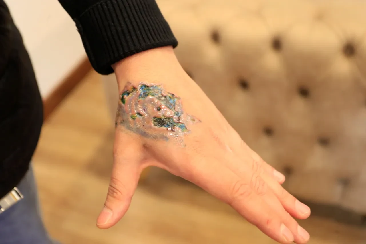 Dövmesini sildirmek istedi, eli delik deşik oldu! Kabusa dönen işlem: Deri nakli yapılacak 