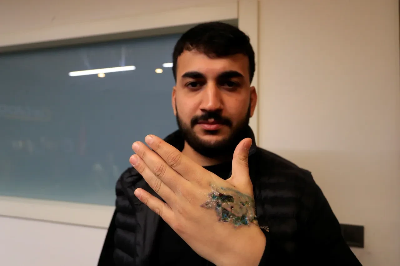 Dövmesini sildirmek istedi, eli delik deşik oldu! Kabusa dönen işlem: Deri nakli yapılacak 