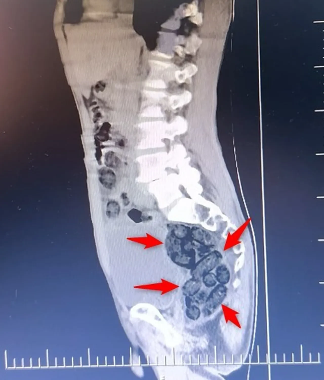 Mide değil, uyuşturucu kapsülü! Şüpheli tavırları ele verdi: Tam 64 parça uyuşturucu midesinden çıktı