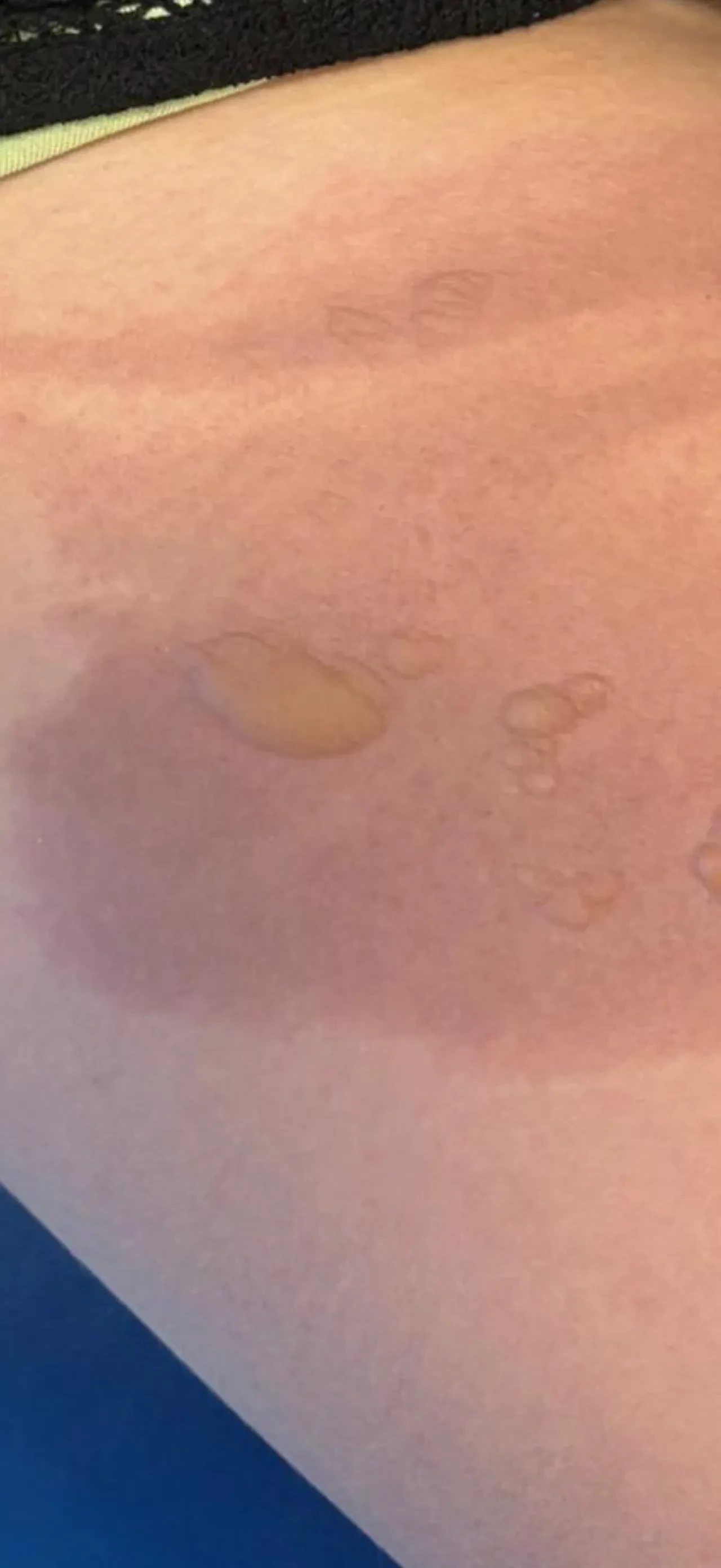 Sıcak su torbası dehşeti yaşattı! 3 dakika sonra patladı: Kendini hastaneye zor attı 