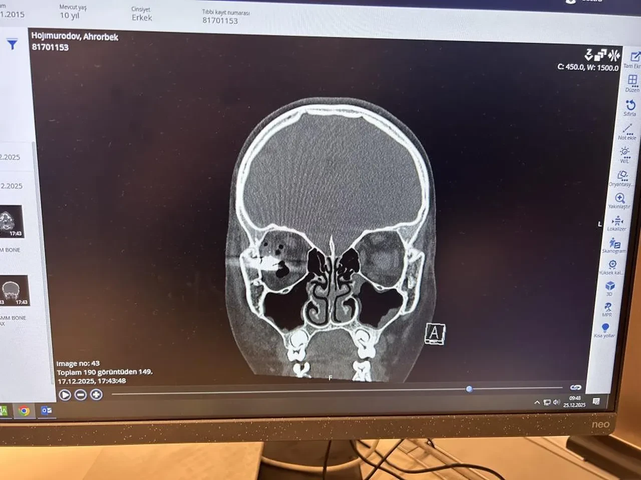 Oynadığı silah ateş aldı, mermi gözüne girip beynine saplandı