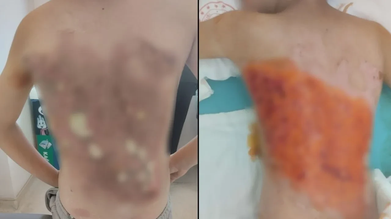 Arnavutköy'de korkunç iddia! 'Kaydıraktan düştü' diye getirdikleri 12 yaşındaki çocuğu yaktıkları ortaya çıktı