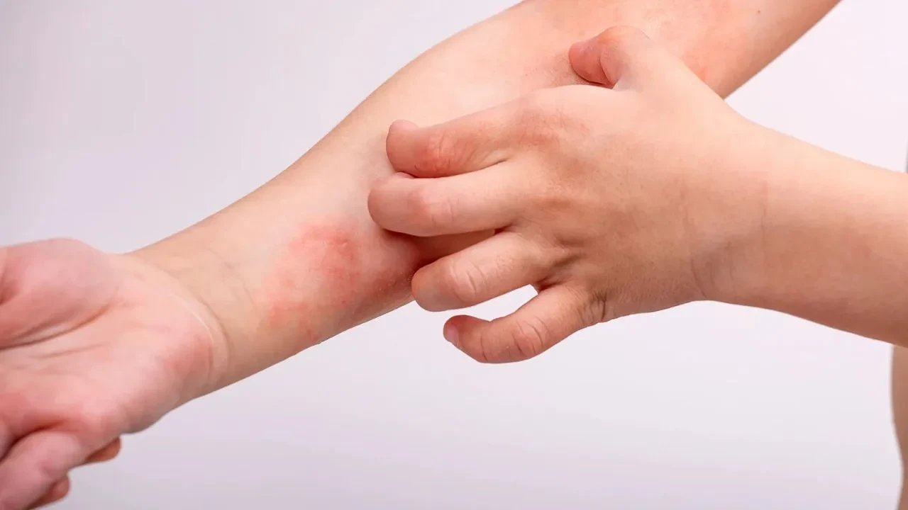 Kortizol miktarı az olan eczane kremleri hangileri? Egzama için en az kortizole sahip kremler