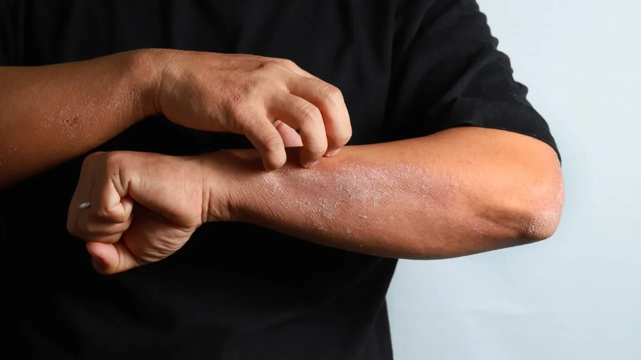Kortizol miktarı az olan eczane kremleri hangileri? Egzama için en az kortizole sahip kremler