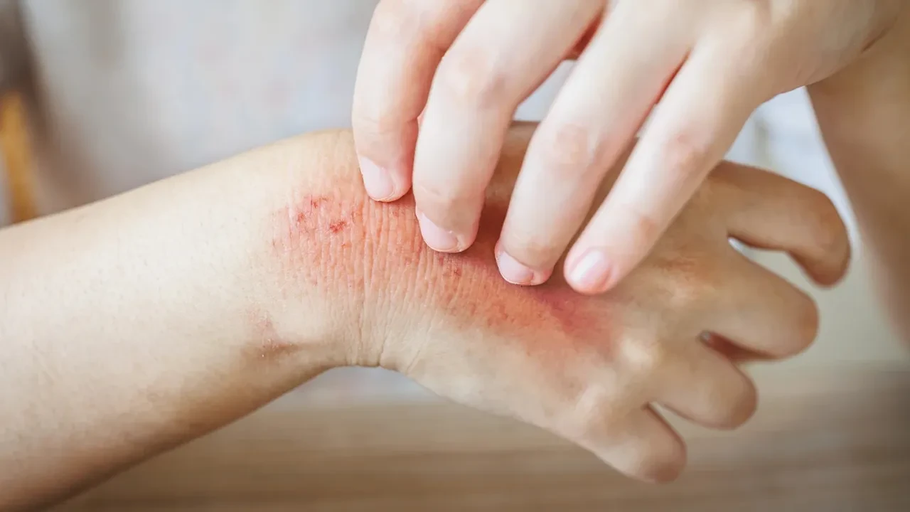 Nistatin krem antibiyotik midir? Nistatin krem ne işe yarar? Nistatin krem kimler kullanır?