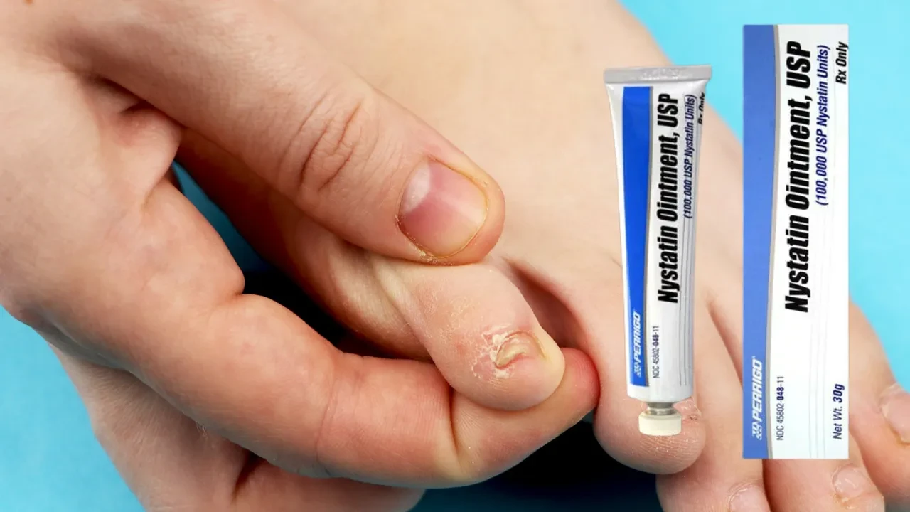 Nistatin krem antibiyotik midir? Nistatin krem ne işe yarar? Nistatin krem kimler kullanır?