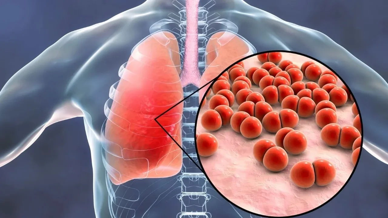 Akut bronşit antibiyotikle geçer mi? Akut bronşit bulaşıcı mı? Akut bronşit ve zatürre arasında fark var mı?