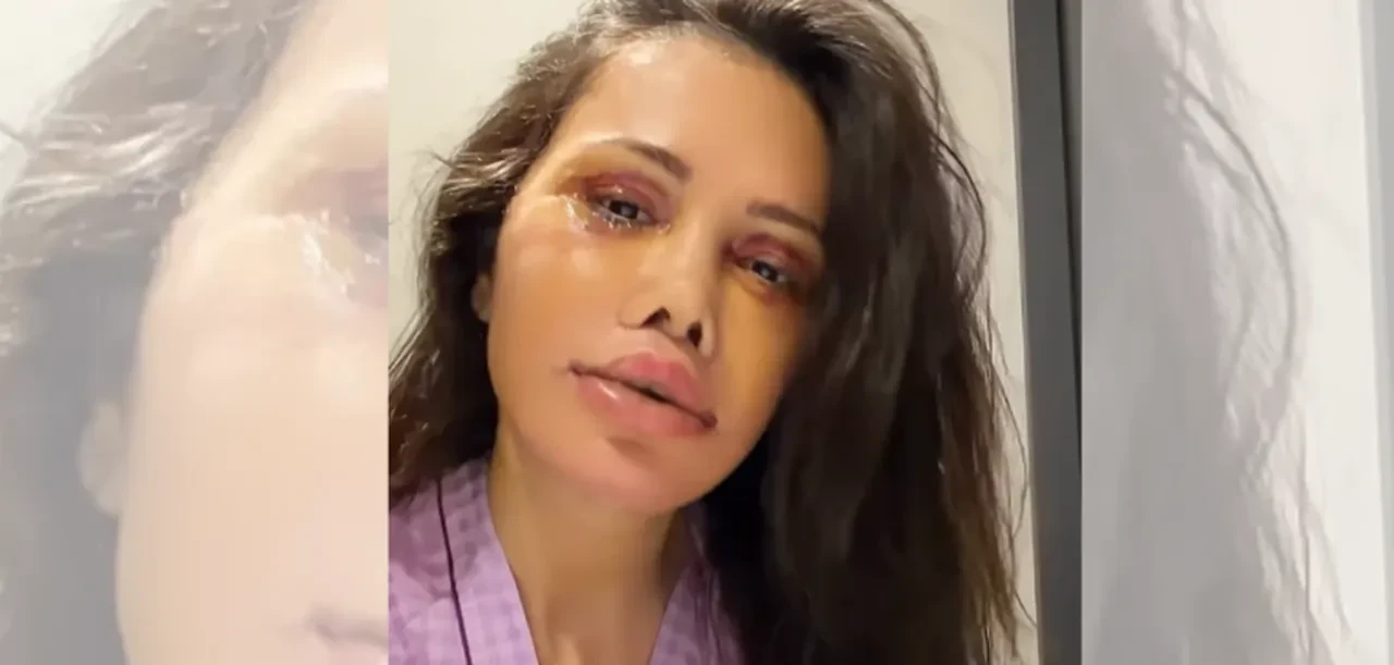 Yüz nakli olan Didem Ceran'dan itiraf üstüne itiraf! "Bugün ilk kez banyo yaptım"