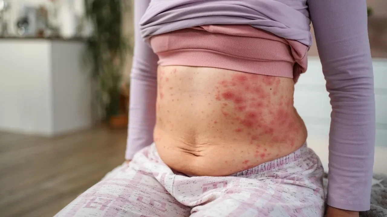 Alerjik vücutlar için İbn-i Sina’dan şifa karışımı! Cilt rahatsızlıklarına son