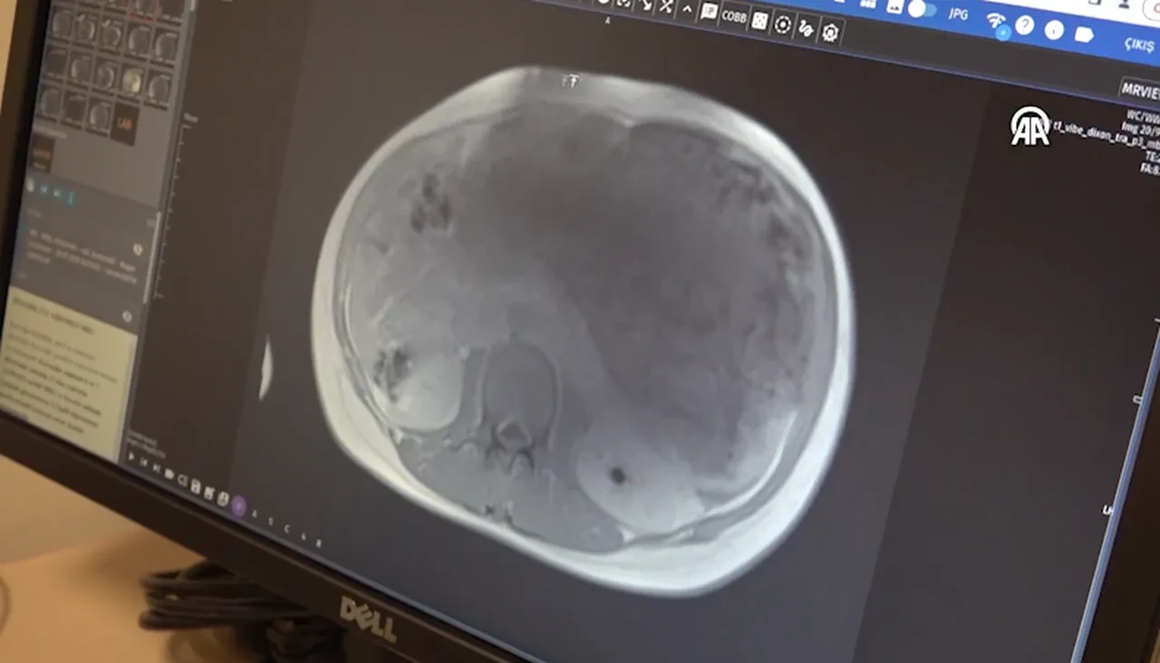 Tıp dünyasında nadir görülüyor, iki bebek büyüklüğünde! Kayseri'deki Kazakistanlı kadının karnından çıkanlar şoke etti