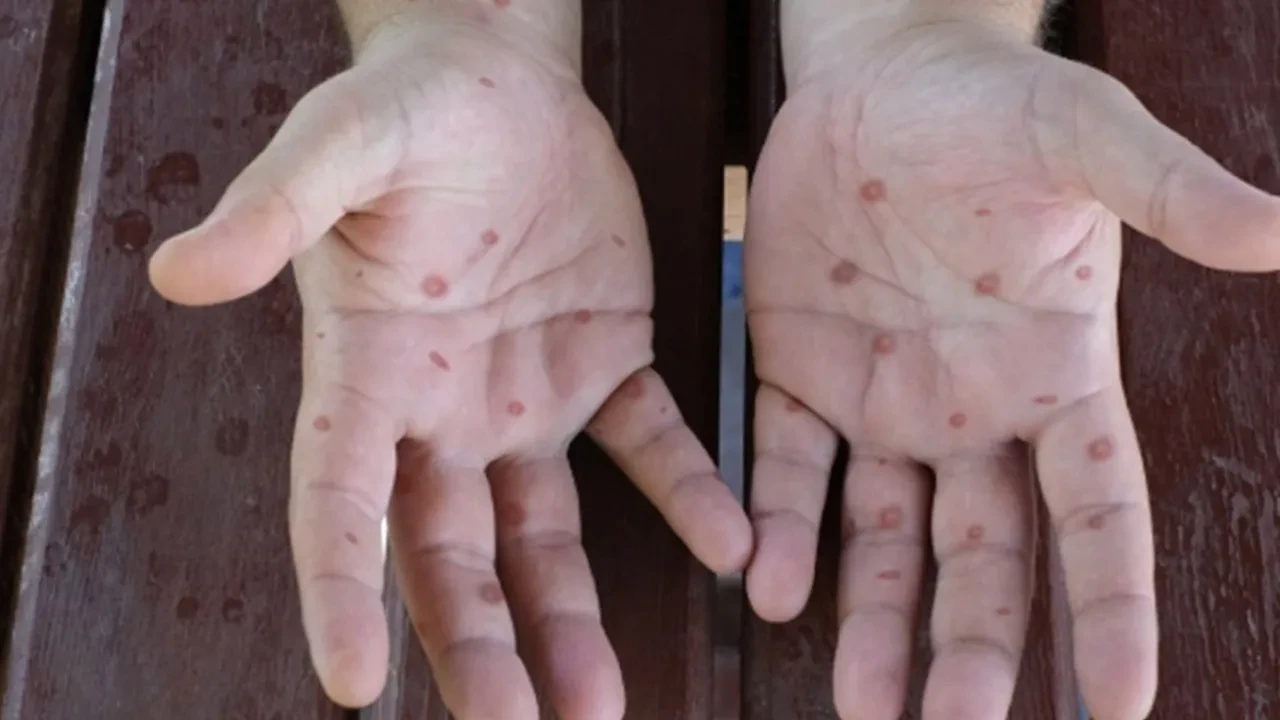 M çiçeği virüsü vakası sonrası bölgede kırmızı alarm! Fransa'nın denizaşırı topraklarında ortaya çıktı