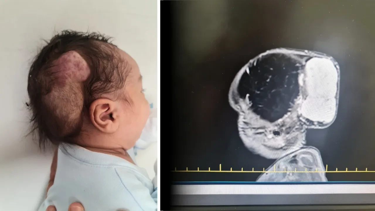 Talha bebek hayata tutundu! Tümörün tamamı temizlendi