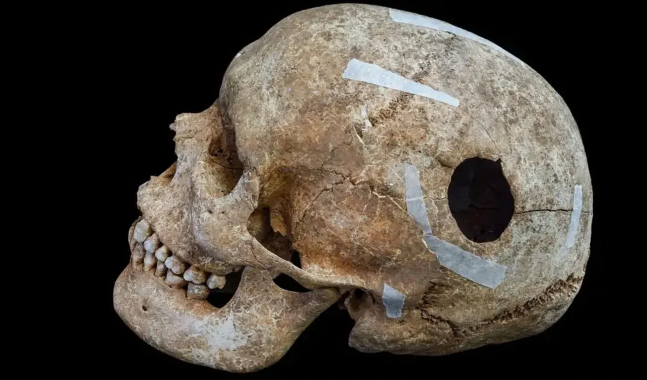 Viking Çağı'na ait kafatası bulundu! Arkeologlar gördüklerine inanamadı: Dünyanın ilk cerrahi operasyonu