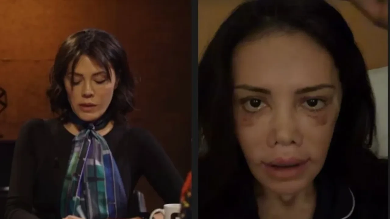 Survivor yarışmasıyla tanınan Didem Ceran, “Yüz naklimin 17. günü" diyerek son halini paylaştı