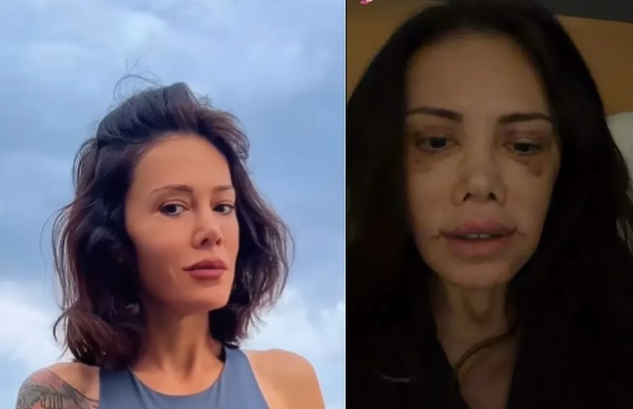 Survivor yarışmasıyla tanınan Didem Ceran, “Yüz naklimin 17. günü" diyerek son halini paylaştı 