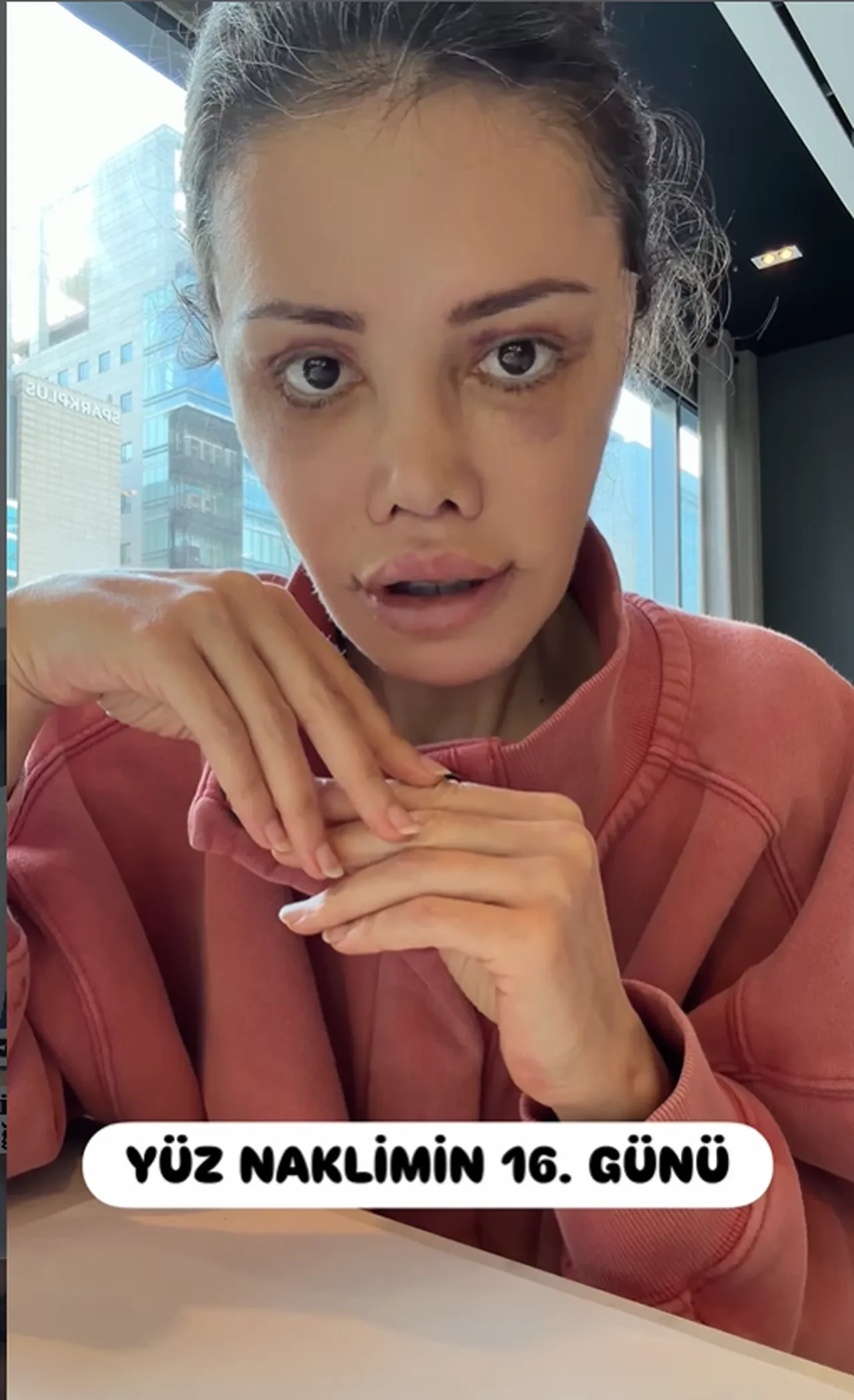 Survivor yarışmasıyla tanınan Didem Ceran, “Yüz naklimin 17. günü" diyerek son halini paylaştı 