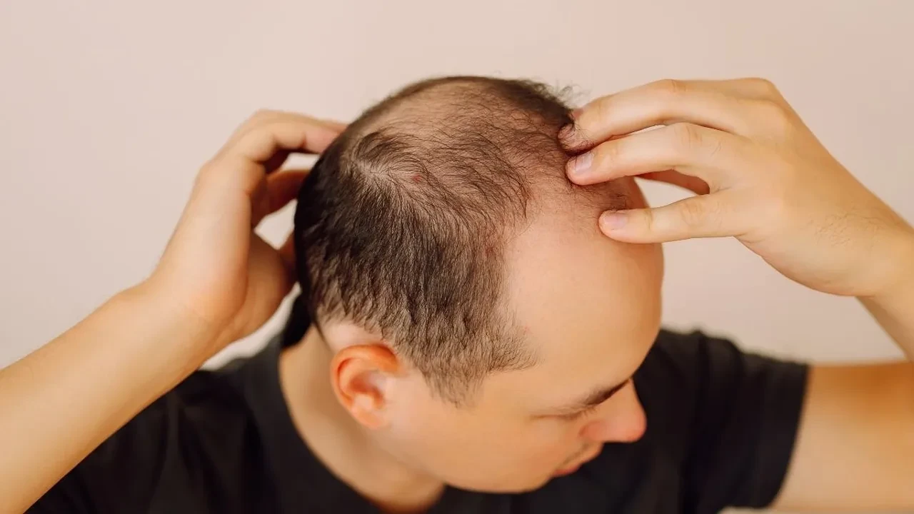 Saç dökülmesi hakkındaki tüm bildiklerinizi unutun! İbn-i Sina’dan en etkili tarif