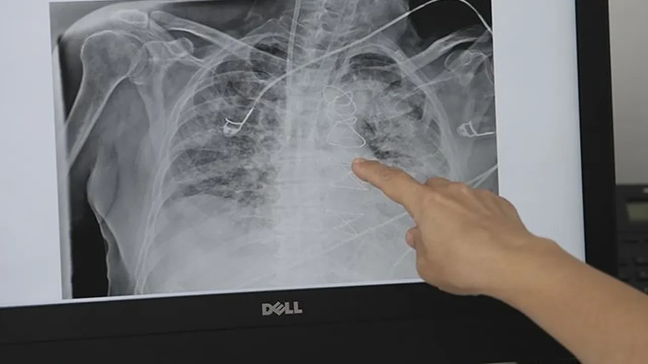 Yüz kişiden 1'inde görülüyor! Uzman isimden kritik uyarı: "Yüksek ölüm oranı olan bir hastalık"