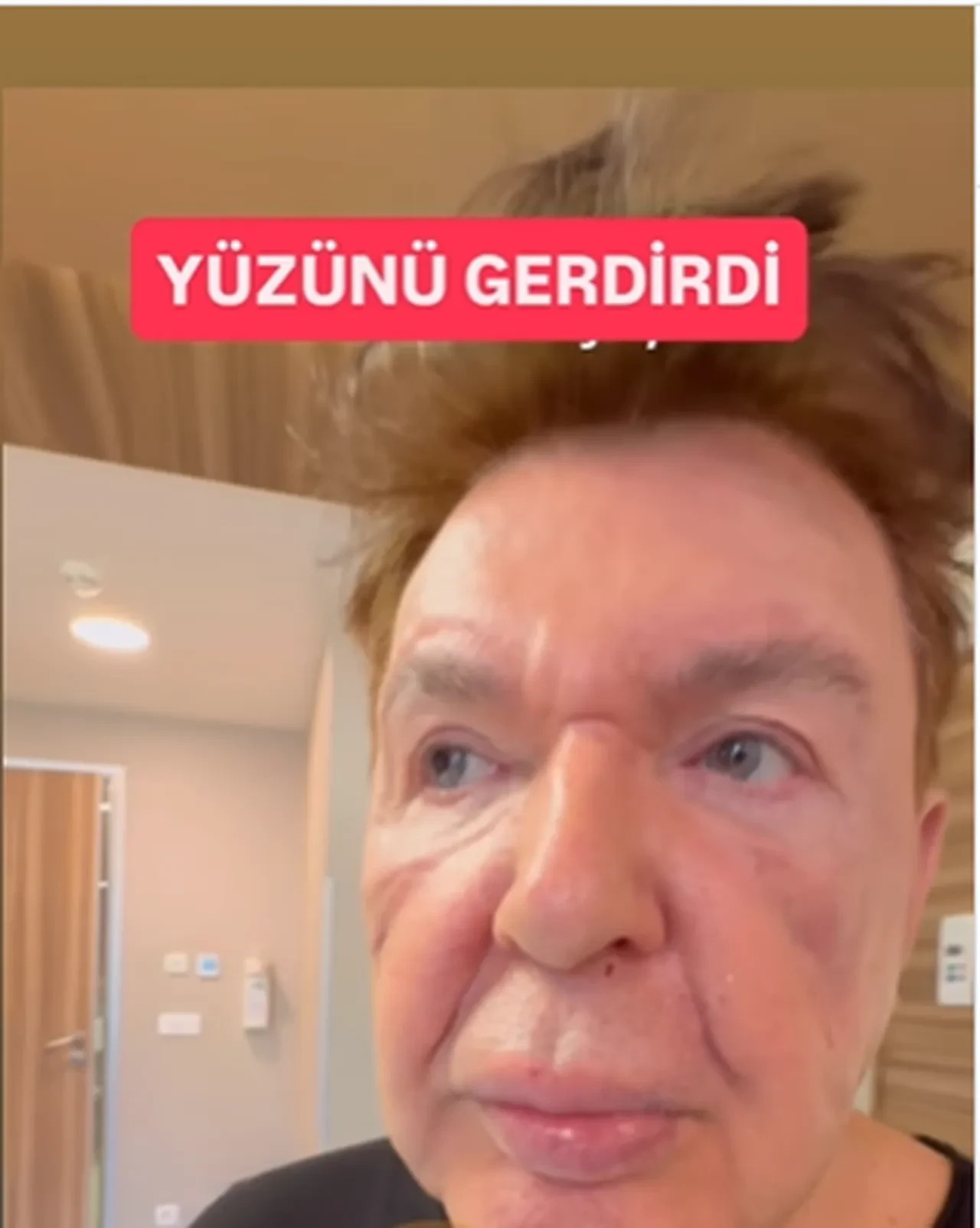 Kuşum Aydın yüzündeki dolgulardan kurtulmak için ameliyat oldu! İşlem öncesi son hali çok konuşuldu 