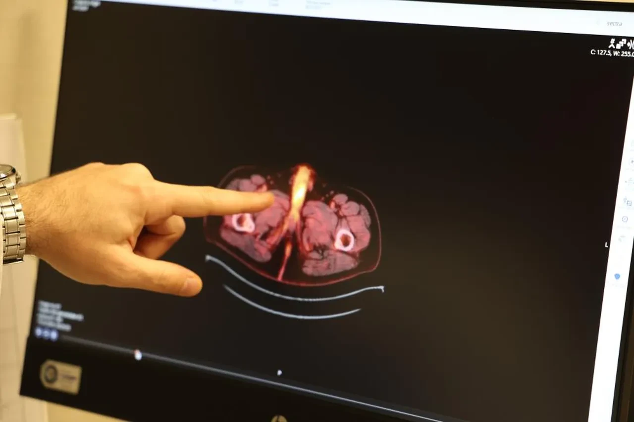 Dünyada 60 kişide var! Son vaka Diyarbakır'da görüldü