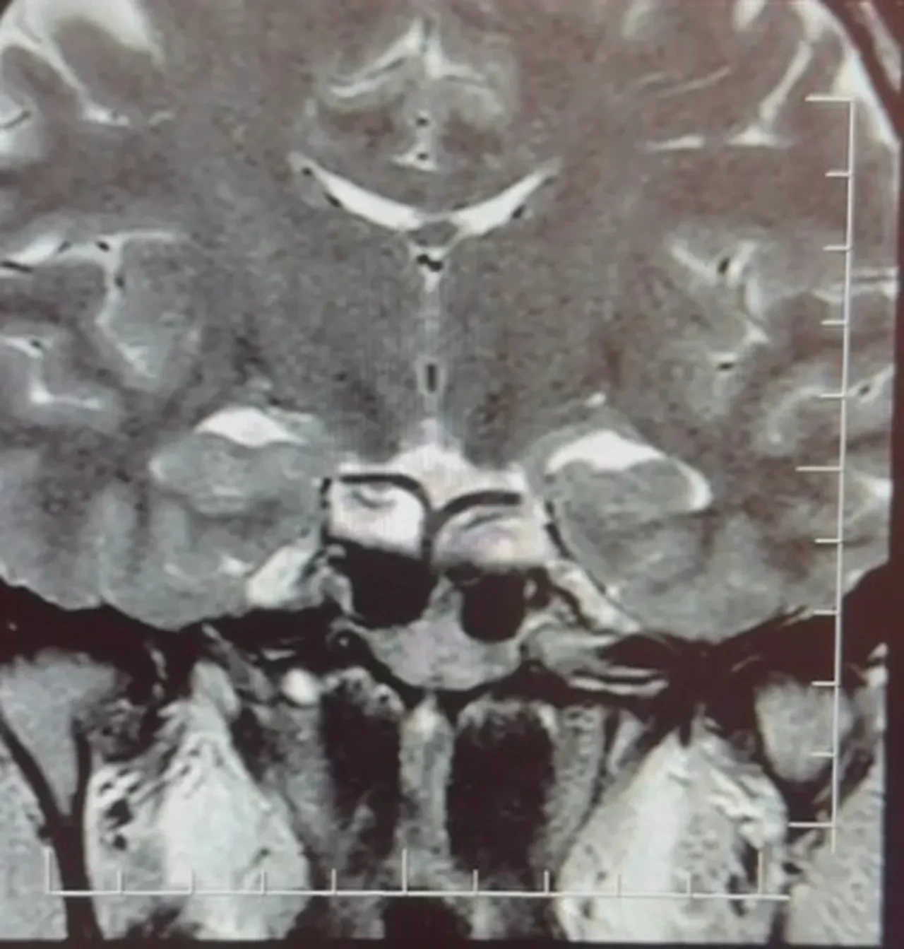 Hamileyim diye doktora gitti: Beyninde tümör çıktı
