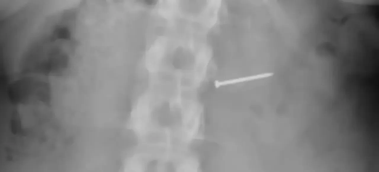 Dondurmasındaki çivi hayatını mahvetti, rekor tazminat aldı