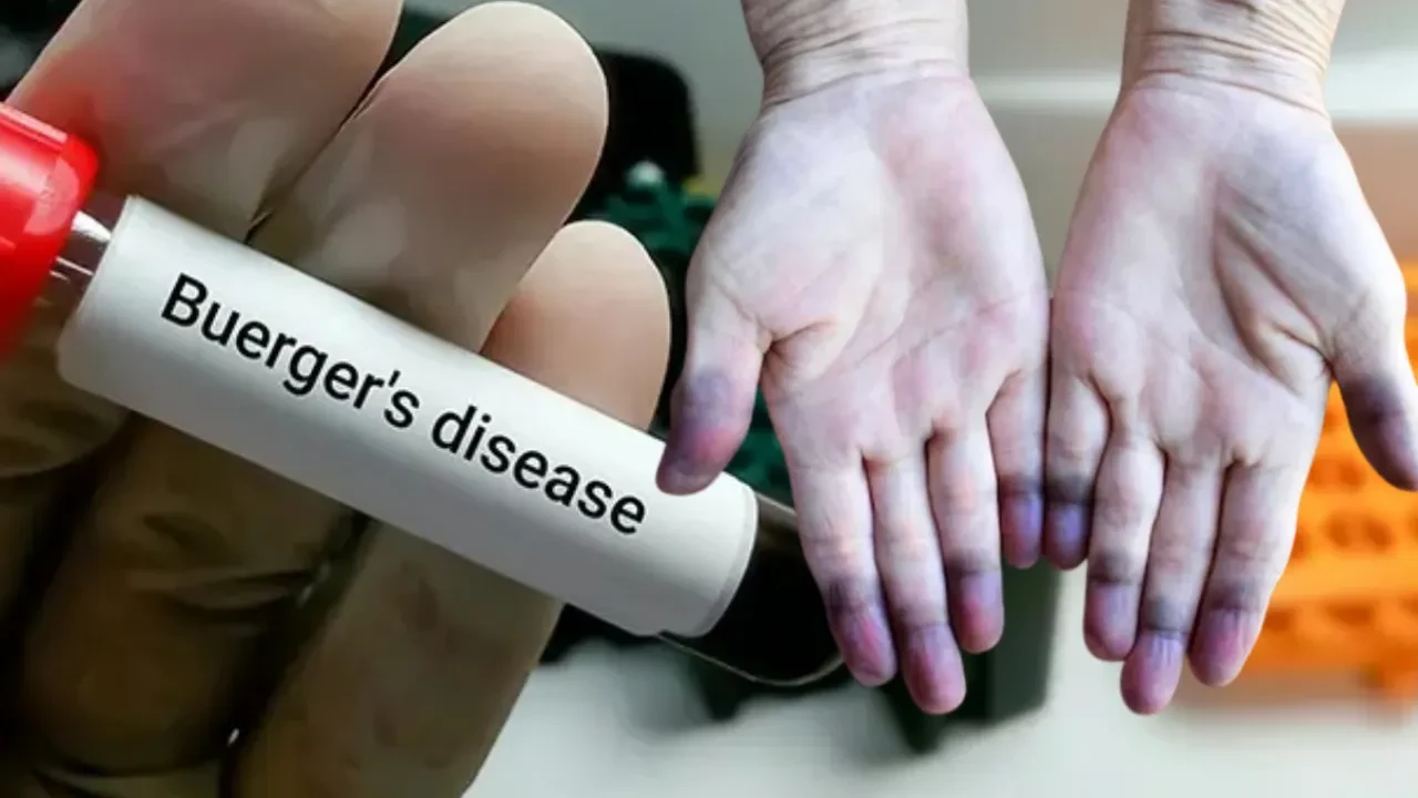 Buerger hastalığı kimlerde görülür? Belirtileri ve tedavisi  
