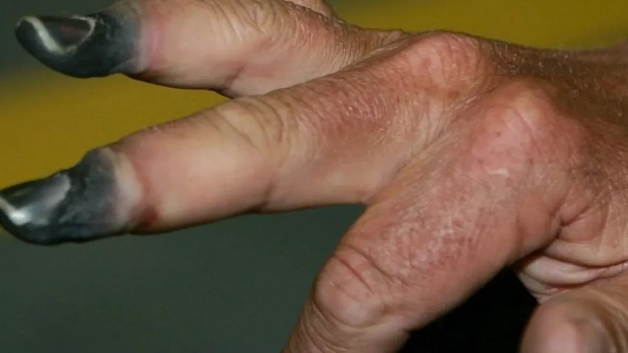 Buerger hastalığı kimlerde görülür? Belirtileri ve tedavisi  