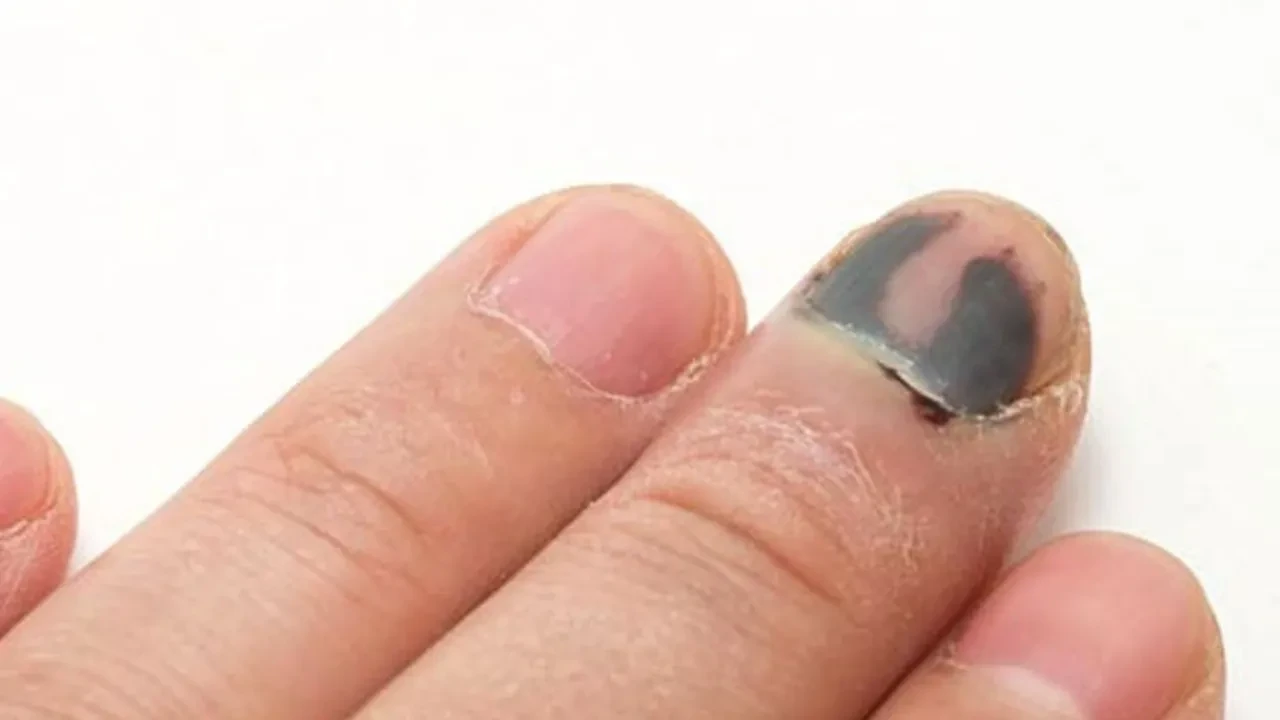 Buerger hastalığı kimlerde görülür? Belirtileri ve tedavisi  