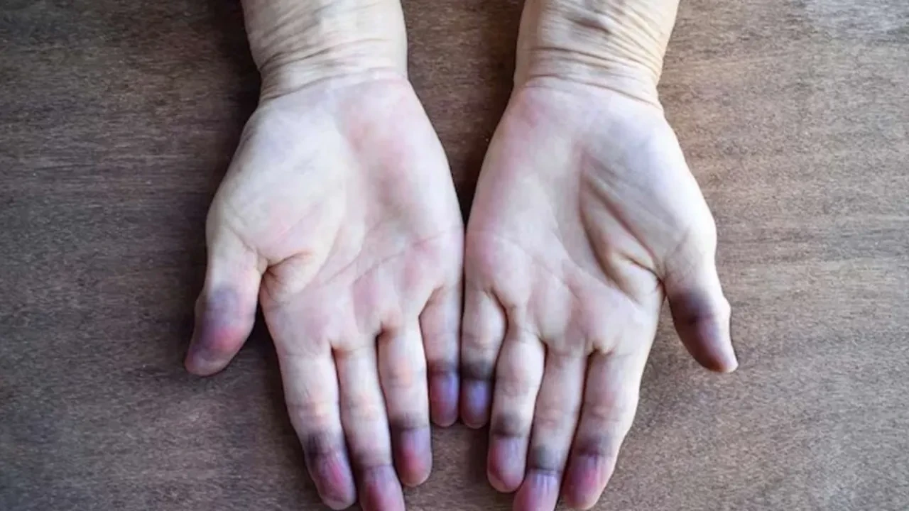 Buerger hastalığı kimlerde görülür? Belirtileri ve tedavisi  