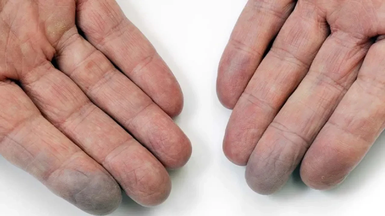 Buerger hastalığı kimlerde görülür? Belirtileri ve tedavisi  