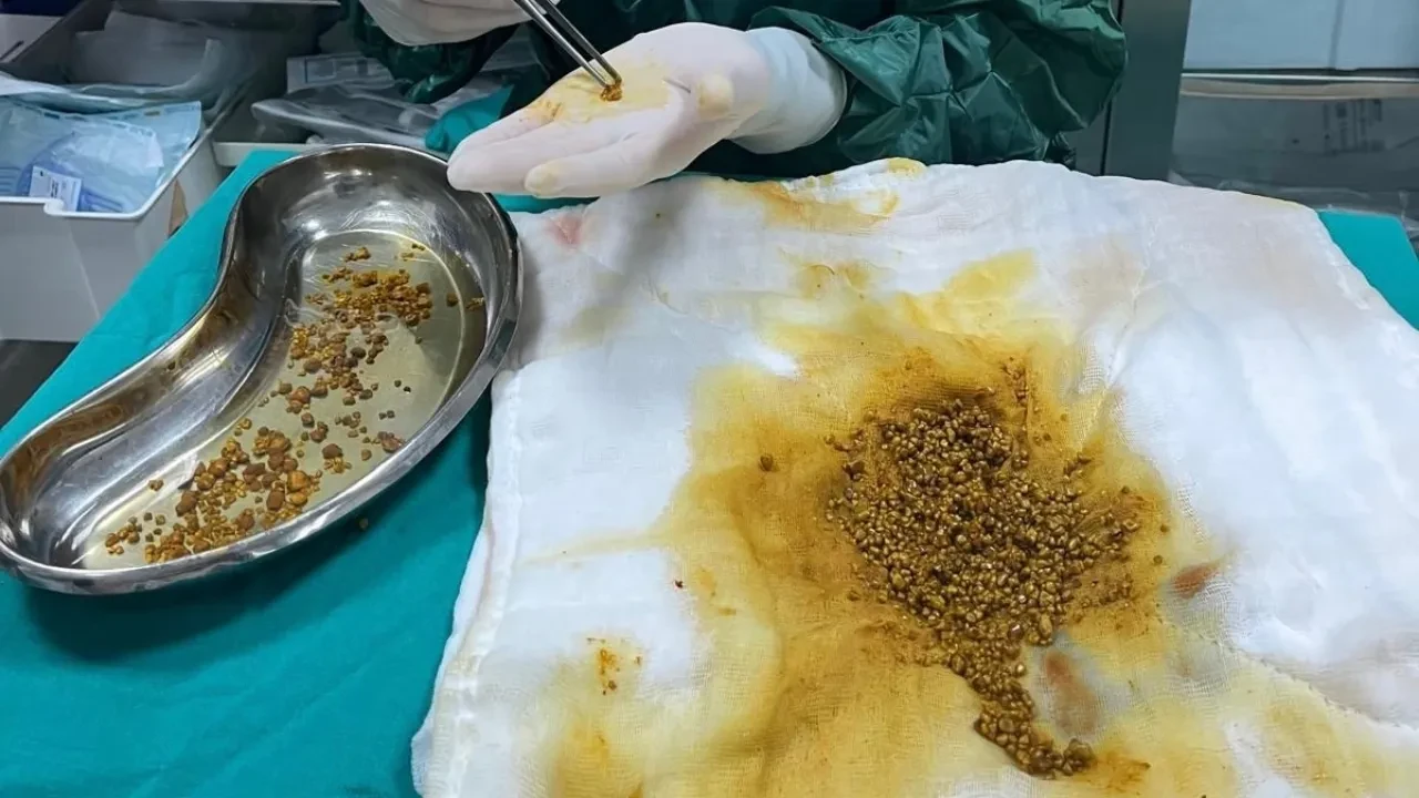 Safra kesesinden binlerce taş çıkarıldı! Bingöl'de nadir görülen vaka şoke etti