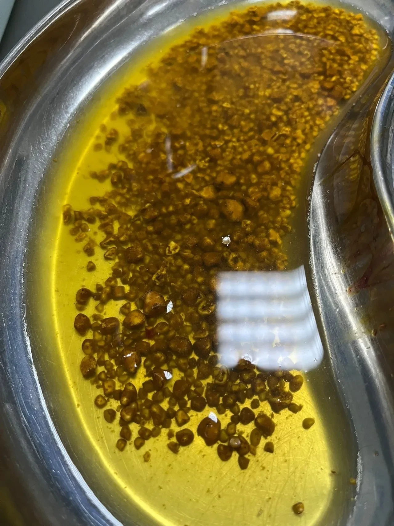 Safra kesesinden binlerce taş çıkarıldı! Bingöl'de nadir görülen vaka şoke etti