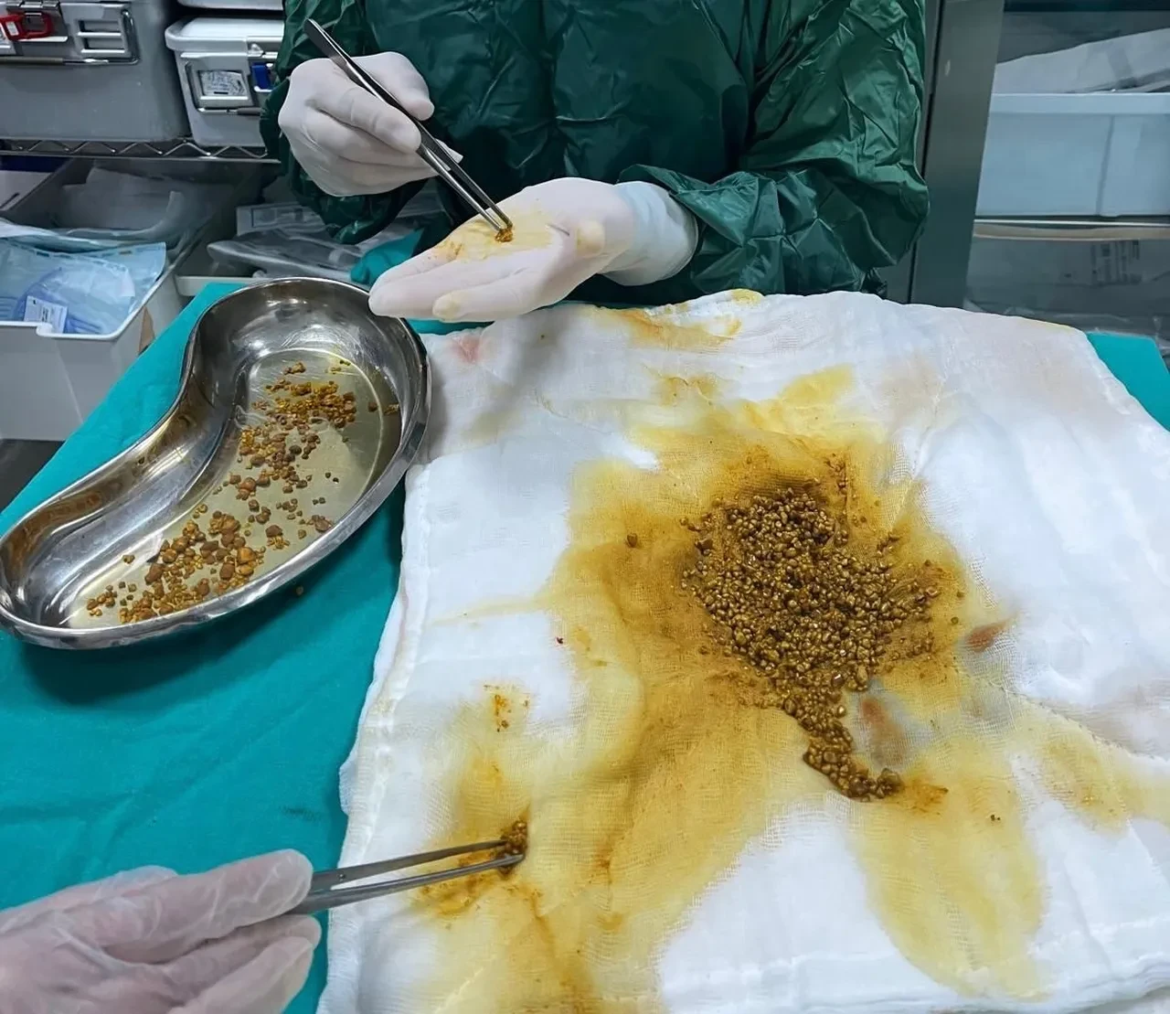 Safra kesesinden binlerce taş çıkarıldı! Bingöl'de nadir görülen vaka şoke etti