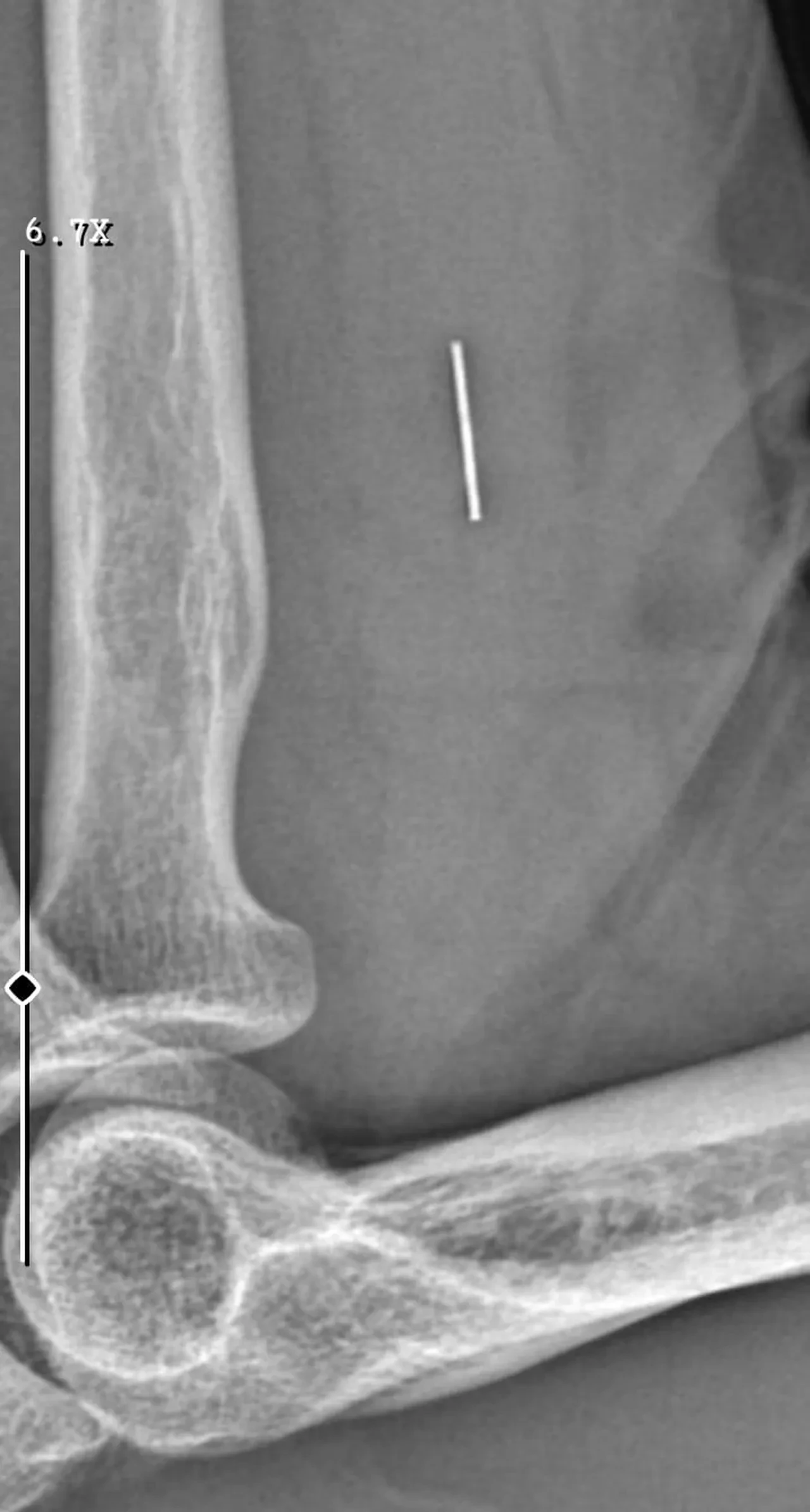 Kurban Bayramı’nda parmağını kesti, tıbbi ihmalin kurbanı oldu! Hem parmağını hem işini kaybetti