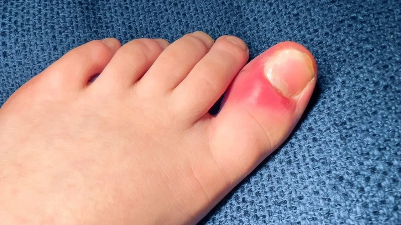 Tırnak batmasını evde geçirmeye çalışmayın! İşte uzman isimden uyarılar