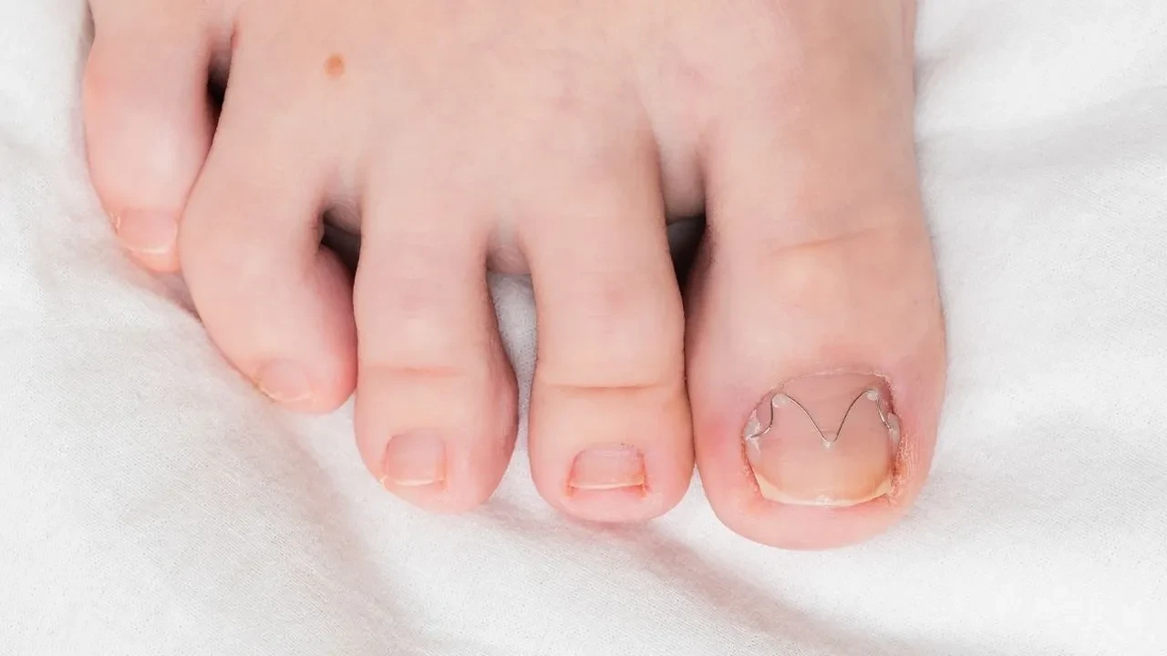 Tırnak batmasını evde geçirmeye çalışmayın! İşte uzman isimden uyarılar