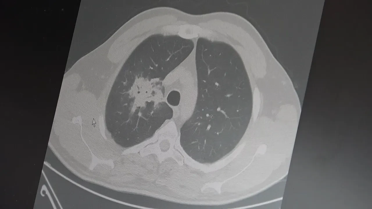 Elektronik sigara için zaman daralıyor! Uzman isim tarih verdi: Patlamış mısır gibi vakalar artacak