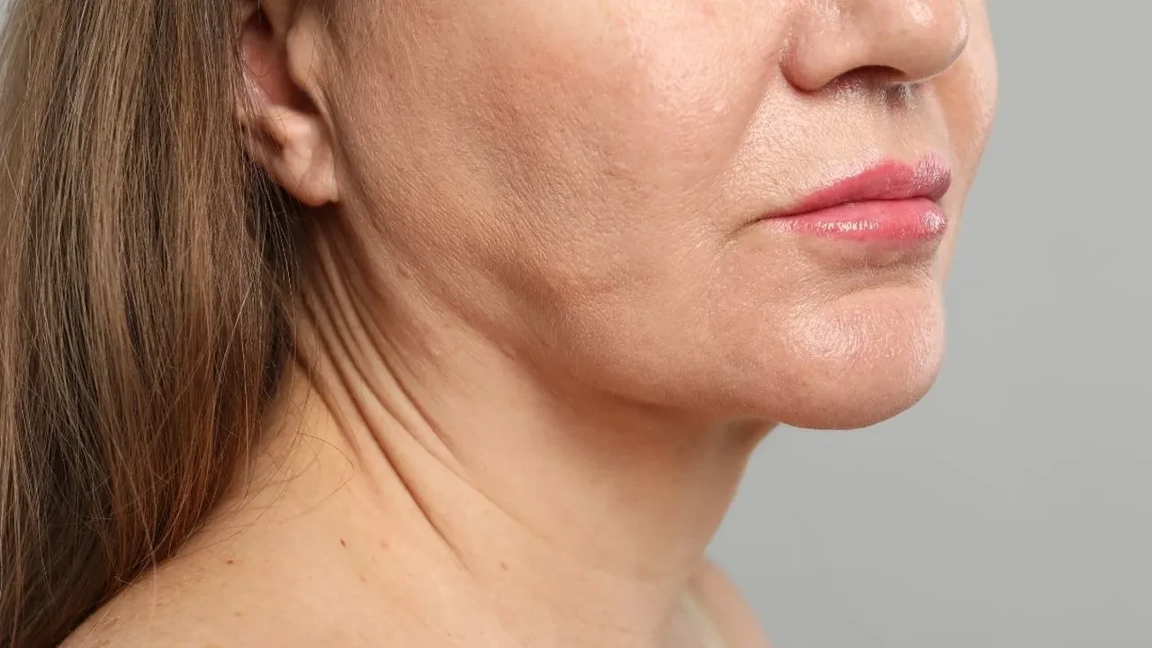 Ebru Gündeş'i 10 yaş gençleştiren Yüz gerdirme işlemi: Mini facelift! Daha genç görünmek isteyenlerin yeni adresi, peki kimler yüz gerdirme yaptırmalı? 