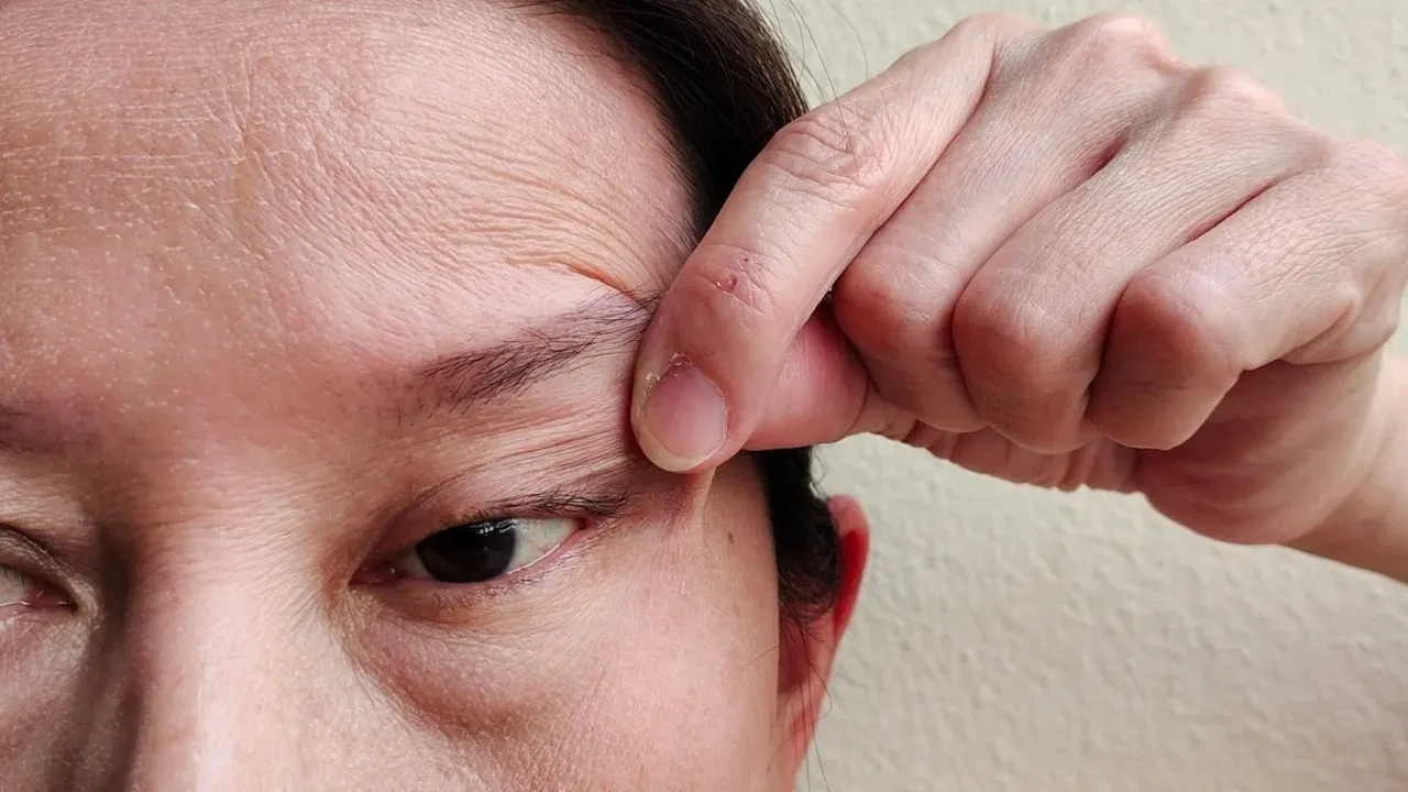 Ebru Gündeş'i 10 yaş gençleştiren Yüz gerdirme işlemi: Mini facelift! Daha genç görünmek isteyenlerin yeni adresi, peki kimler yüz gerdirme yaptırmalı? 