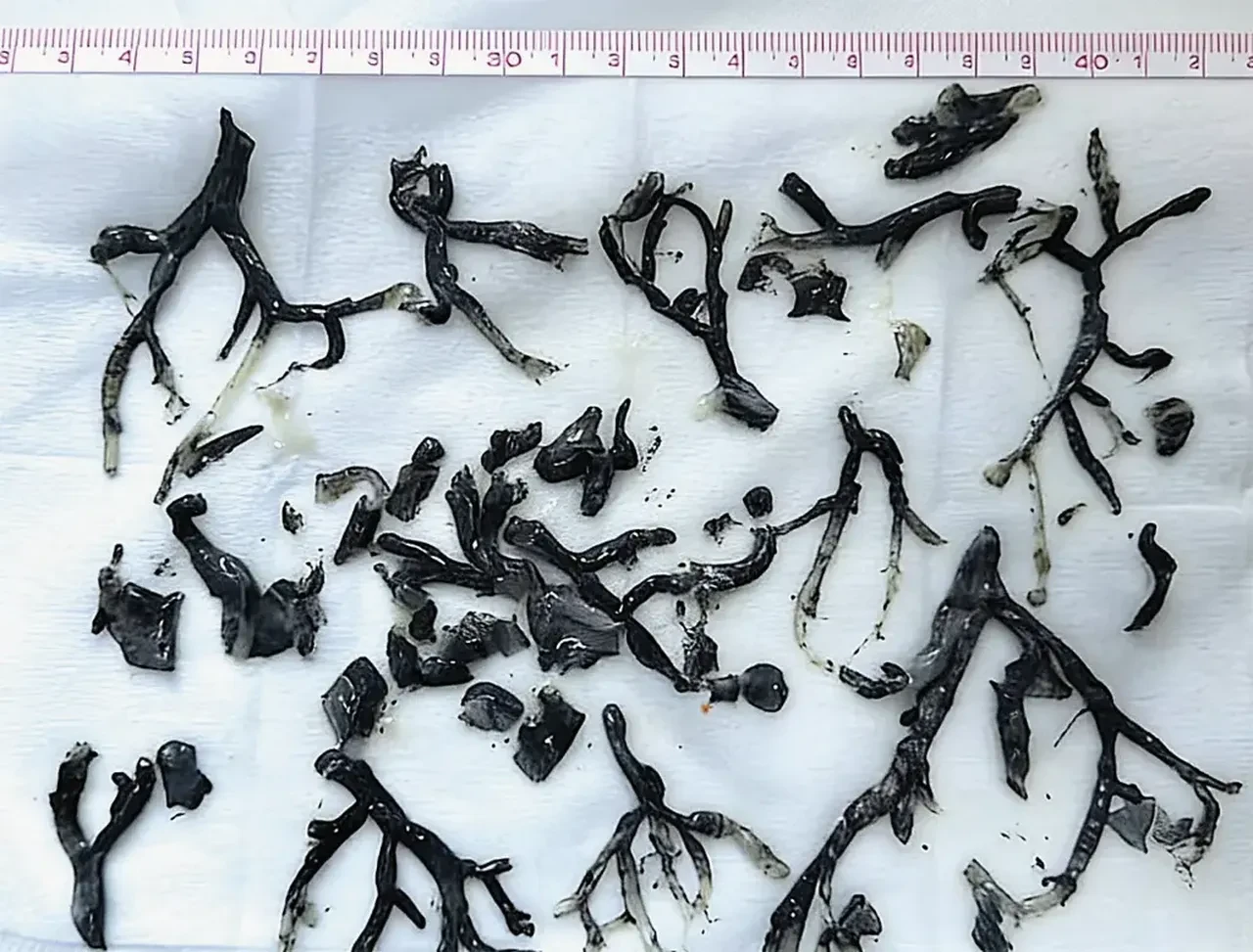 Nefes darlığı şikayetiyle hastaneye gitti, vücudundan çıkanlar şaşkına çevirdi