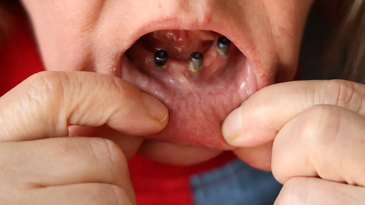 Diş ağrısıyla gitti, 25 dişinden oldu! Deliller kararmasın diye implantları söktüremiyor: 36 çeyrek altın harcadım!