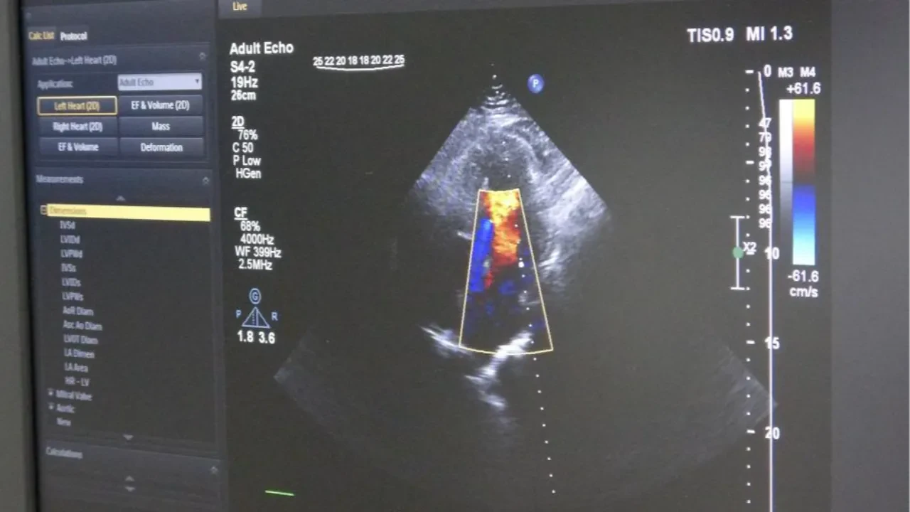 Damar tıkanıklığına “balon” çözümü! Ameliyatsız kurtarıldı, 2 günde sağlığına kavuştu