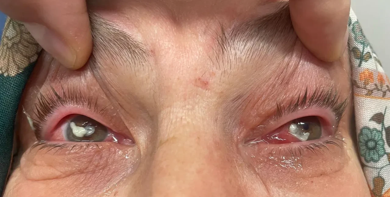 Gözlerine damlattığı Kırlangıç Otu suyu dünyasını kararttı! Gözlükten kurtulmak istedi, önünü göremez oldu