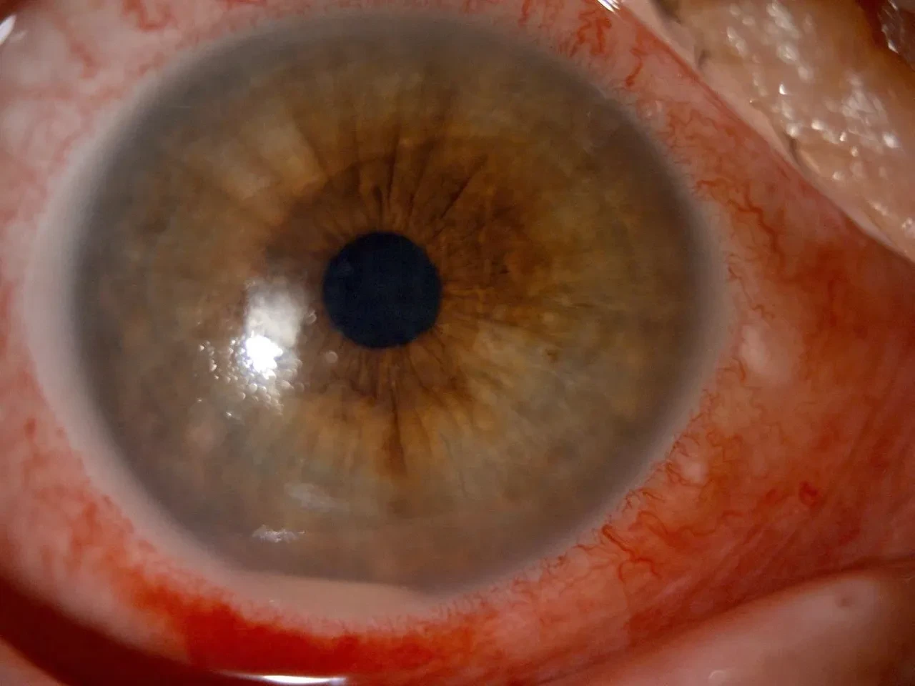 Gözlerine damlattığı Kırlangıç Otu suyu dünyasını kararttı! Gözlükten kurtulmak istedi, önünü göremez oldu