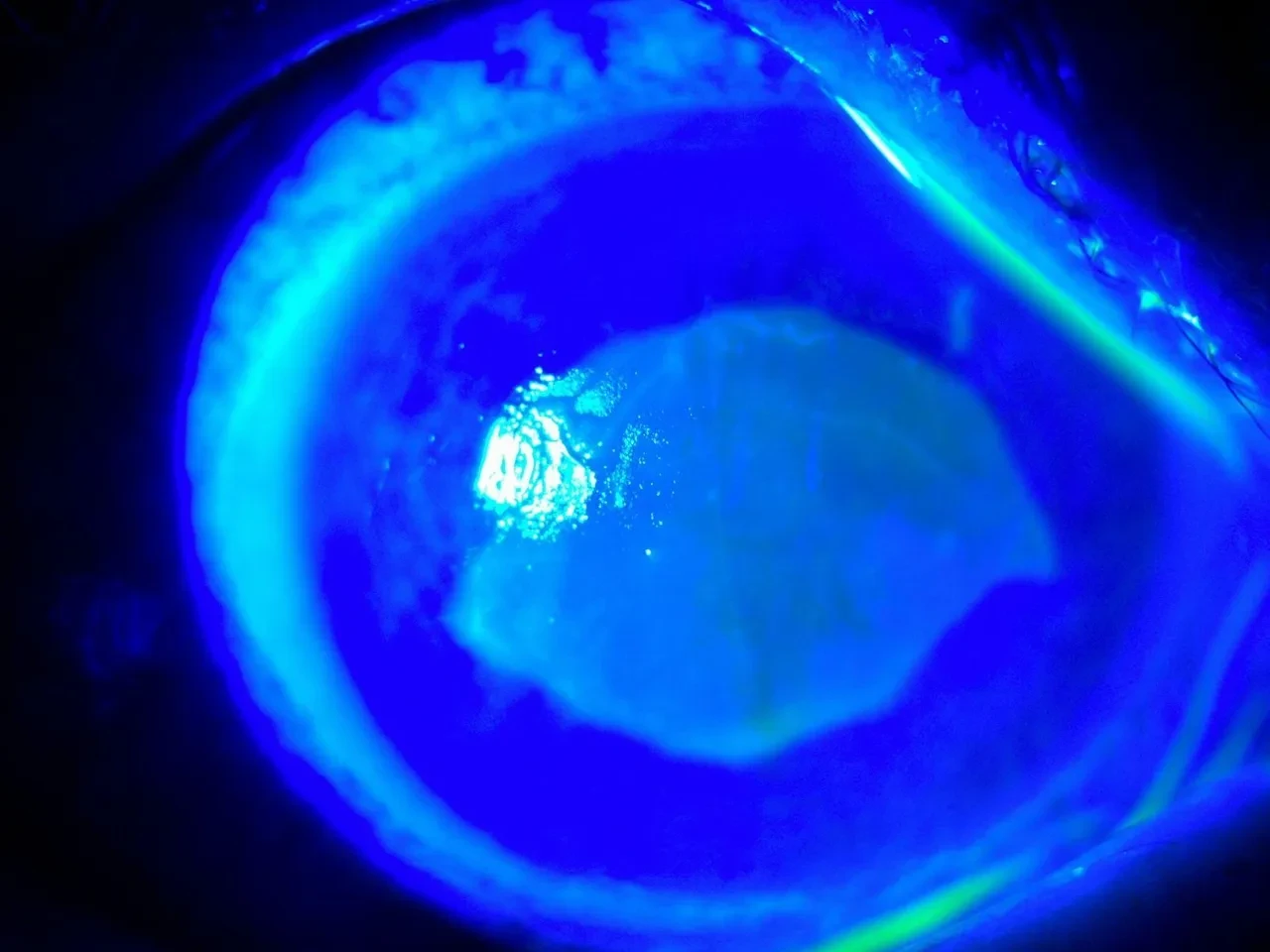 Gözlerine damlattığı Kırlangıç Otu suyu dünyasını kararttı! Gözlükten kurtulmak istedi, önünü göremez oldu