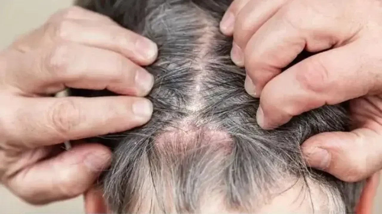 Saç derisindeki kötü koku neden olur? Adeta herkesin kabusu olan konu